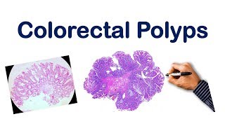 Colorectal Polyps USMLE STEP NCLEX COMLEX [upl. by Cherise]