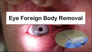 Eye Foreign Body Removal [upl. by Iinde105]