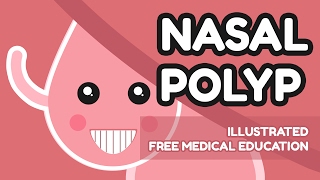 What is Nasal Polyp [upl. by Quenna]