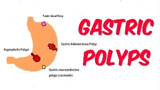 Gastric Stomach Polyps [upl. by Ahsaetal779]