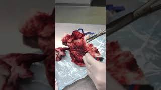 NASAL POLYPS REMOVAL SURGERY [upl. by Ferree]