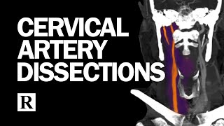 Cervical Arterial Dissections [upl. by Arsi767]