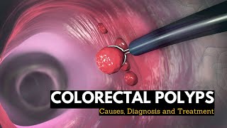 Removal of a Cervical Polyp [upl. by Ivett]