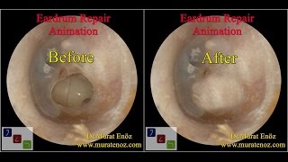 Ear Drum Repair [upl. by Dranyar761]