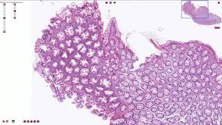 Hyperplastic Polyp  Colon  Histopathology [upl. by Paucker]