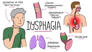 Approach to dysphagia difficulty swallowing  causes pathophysiology investigation [upl. by Ahsinam]